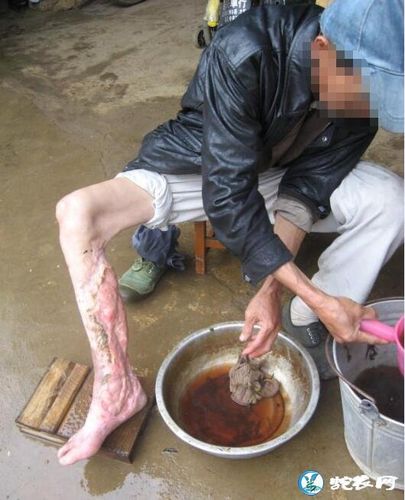 养毒蛇之前的生死必修课 眼镜蛇咬伤的治疗与防范
